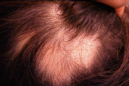 Bald Patches, Hair Loss in Patches, Stress Hair Loss - photo