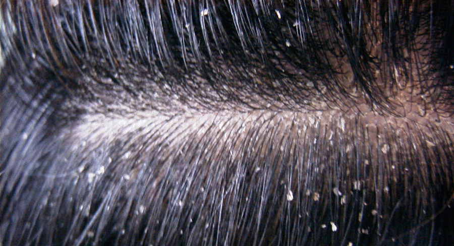 Dandruff Treatments, Dry Itchy Flaky Scalp Treatments - Hairology.co.uk - 'The Root to Healthier Hair'.