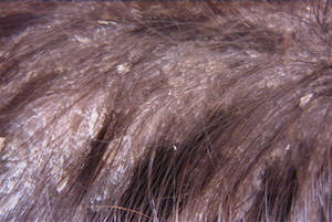 Itchy Flaky Scalp Treatments - Hairology.co.uk - 'The Root to Healthier Hair'.