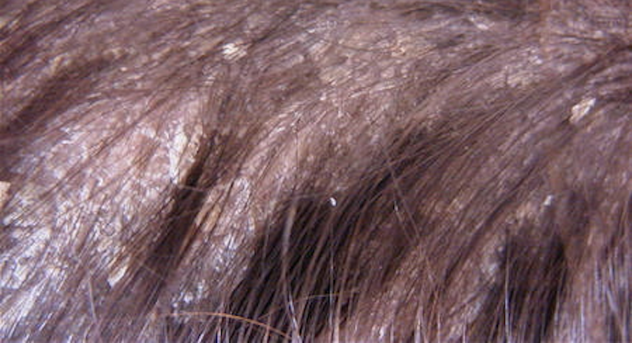 Itchy Flaky Scalp Treatments - Hairology.co.uk - 'The Root to Healthier Hair'.