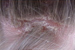 Scalp Psoriasis - Flaky Itchy Scalp - Hairology.co.uk