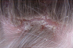scalp psoriasis treatment uk